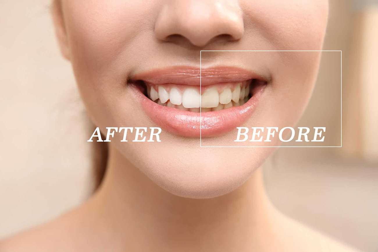 What Are the Most Effective Natural Teeth Whitening Methods You Can Try Maidenhead?