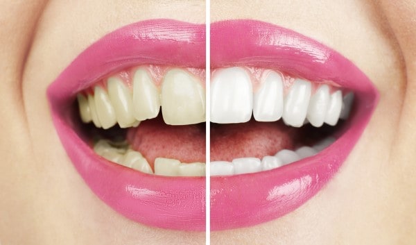 What Makes Ultima White Teeth Whitening Different Maidenhead