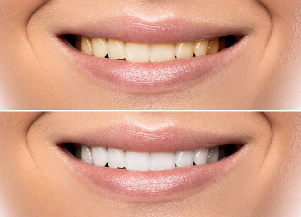 How Does Gum Disease Progress if Left Untreated Maidenhead?