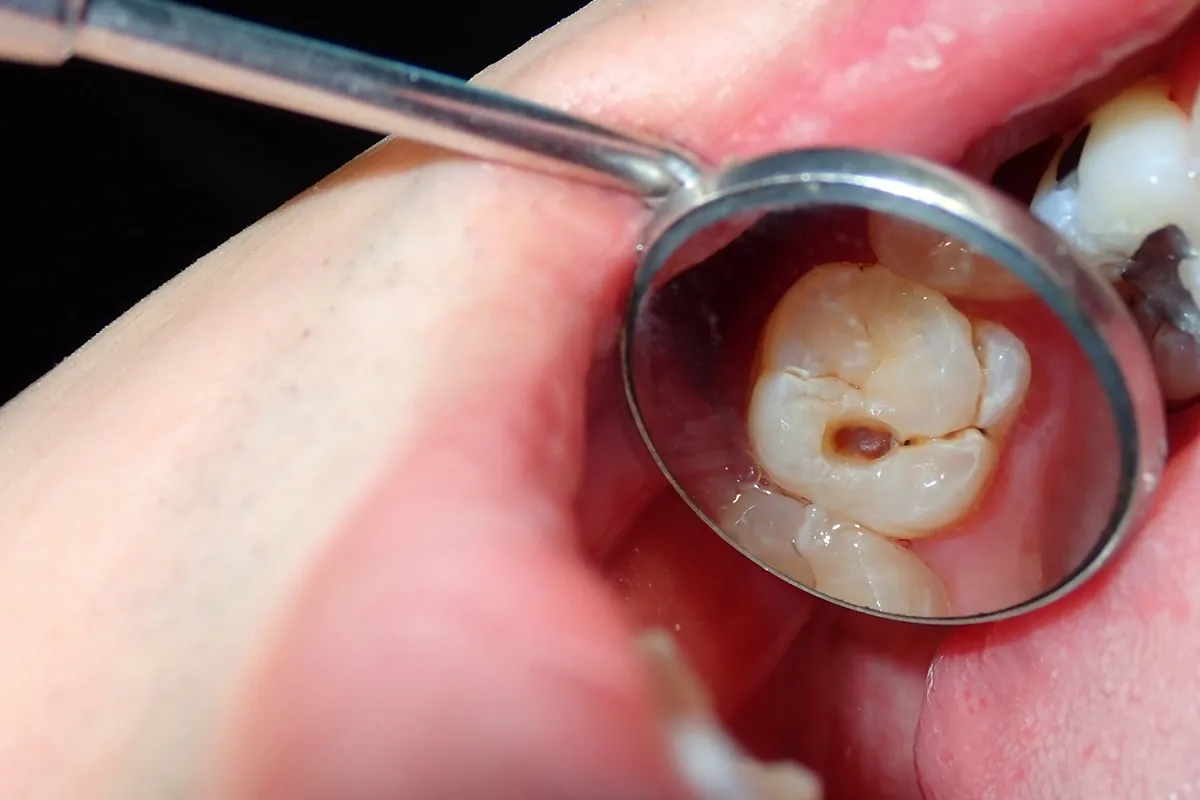 Why Do Teeth Crack? Common Causes to Know Maidenhead