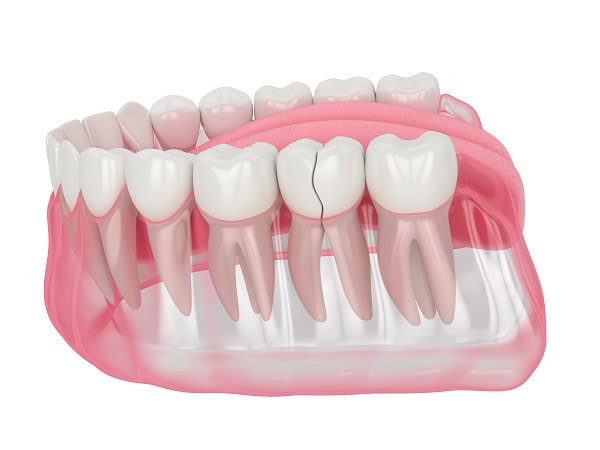 How Can You Manage Pain and Discomfort After a Root Canal Maidenhead?