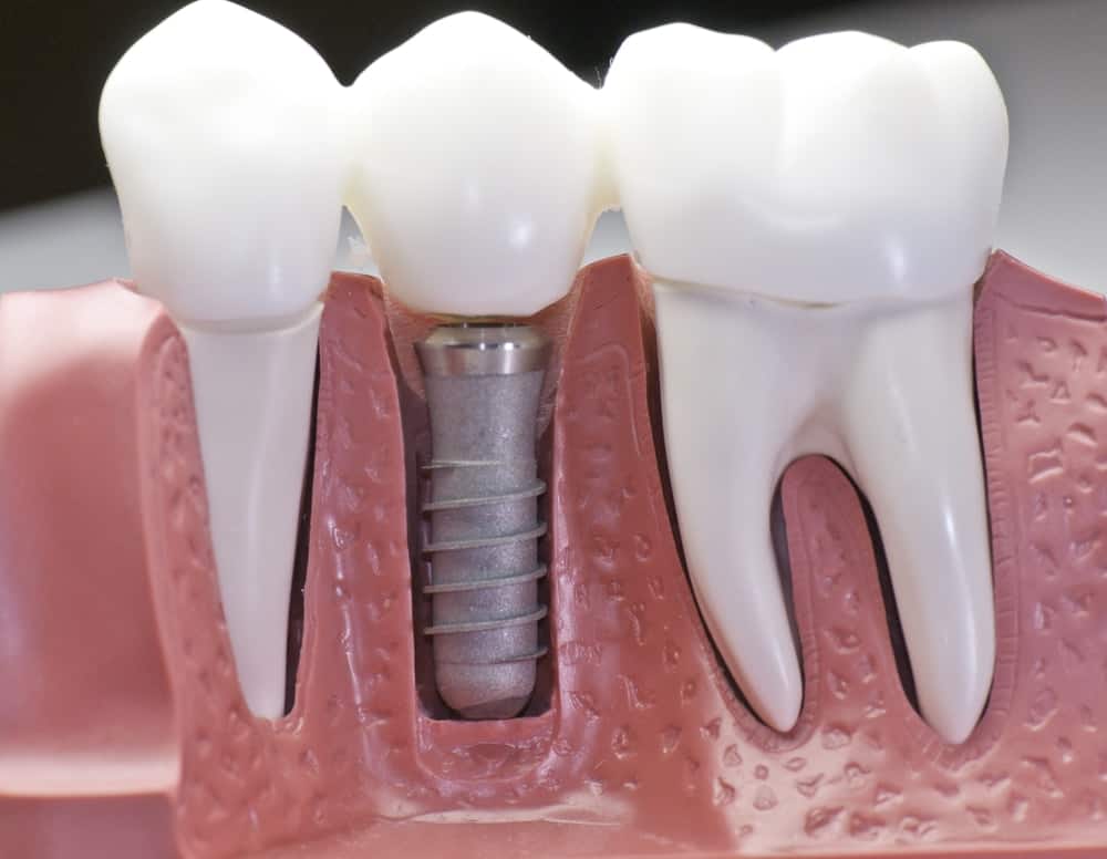 Who Is a Good Candidate for Dental Implants Maidenhead?