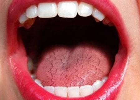 Common Causes of Dry Mouth (Xerostomia) Maidenhead