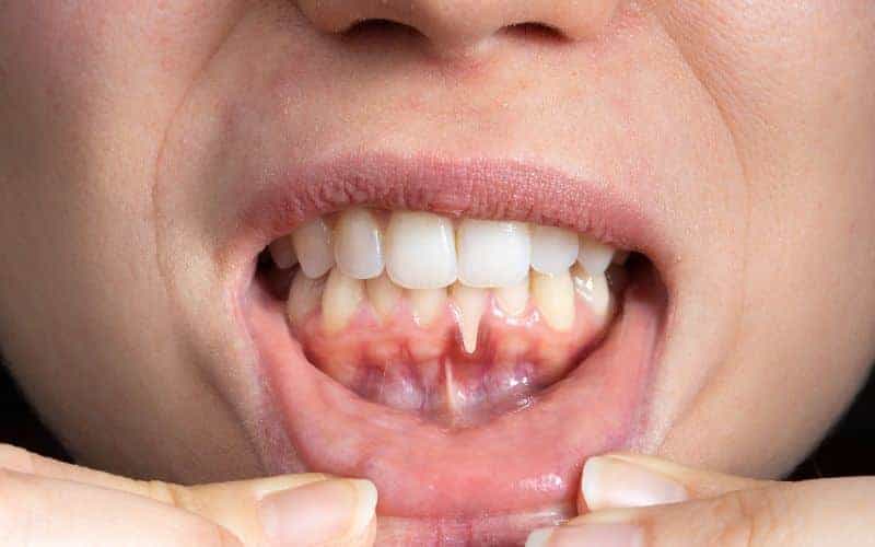 How Can Gum Disease Be Prevented Maidenhead?