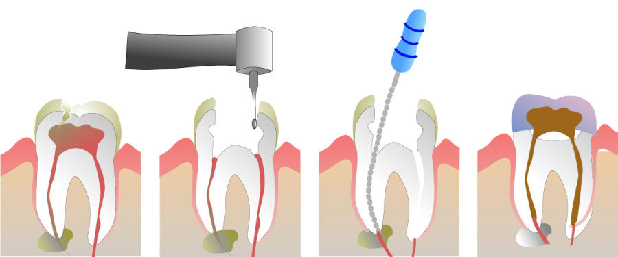 How Do You Properly Care for Your Teeth After a Root Canal Maidenhead