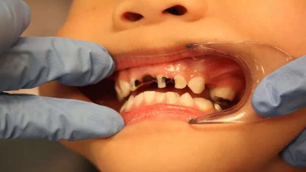 Which Foods and Drinks Cause the Most Damage to Young Smiles Maidenhead?
