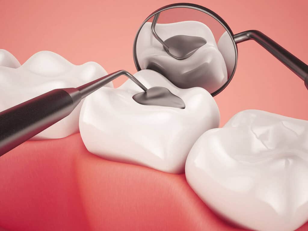 Fighting Cavities and Plaque Buildup Maidenhead