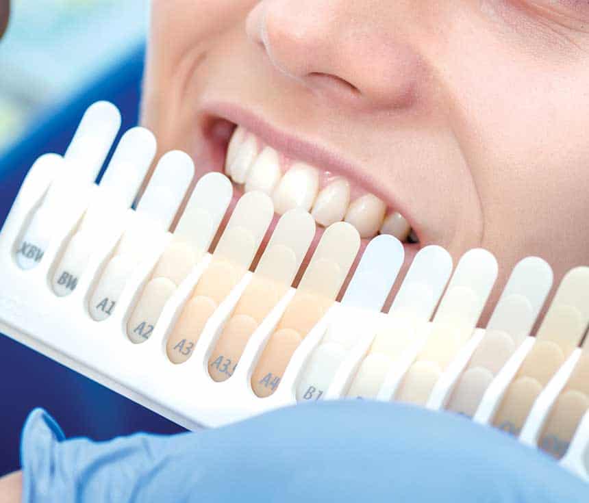 Professional vs At-Home Whitening: What You Need to Know Maidenhead