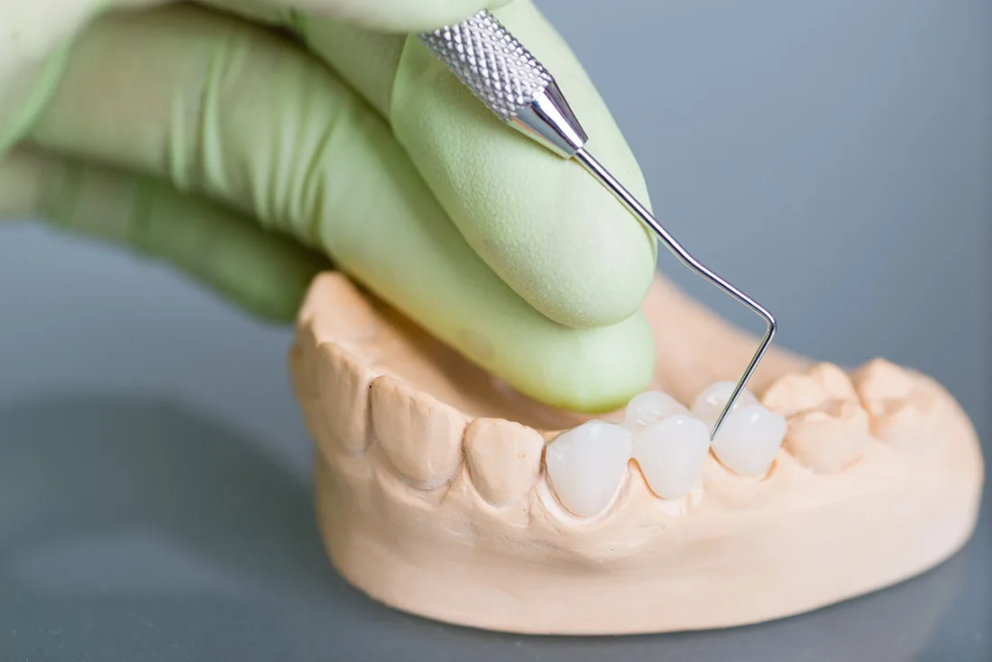 What Are the Different Types of Dental Crowns Available Maidenhead?