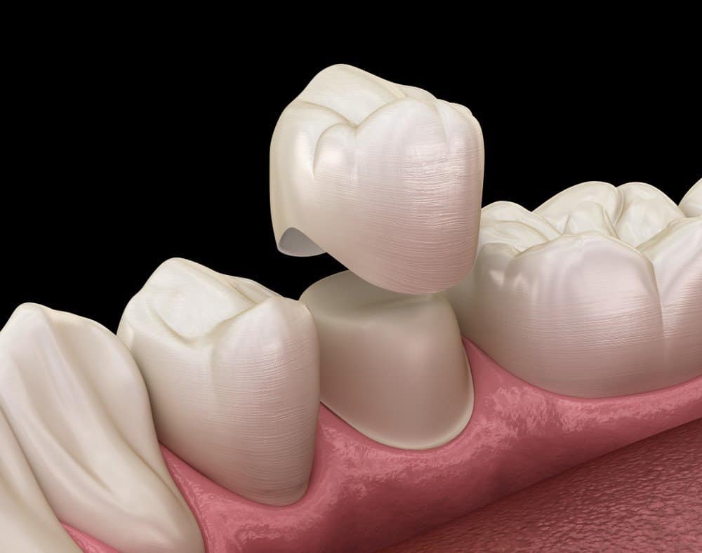What is the Procedure for Getting Dental Implants Maidenhead?