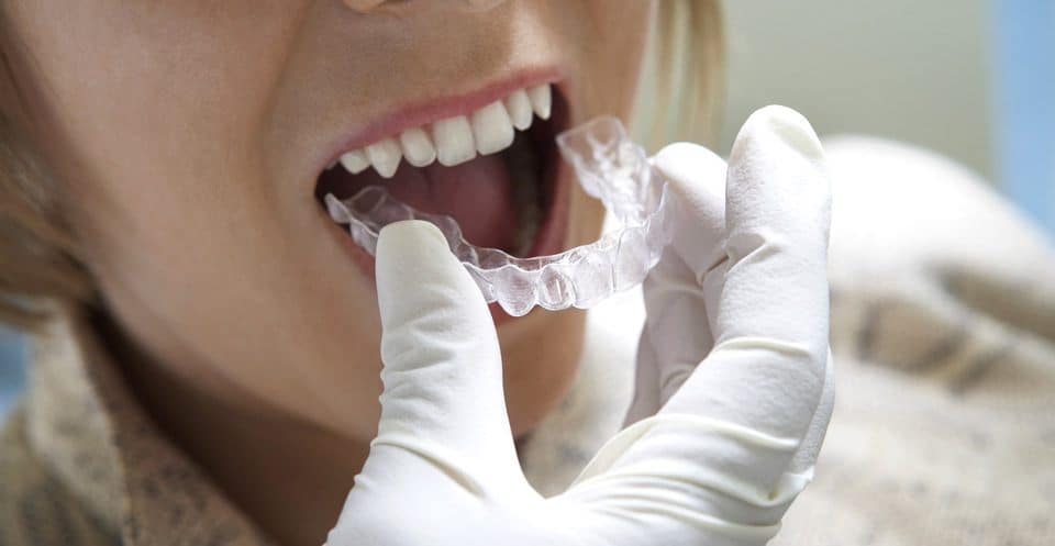 How Much Does Laser Teeth Whitening Cost Compared to Overnight Trays Maidenhead?